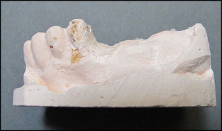 Michener, James. (1907 - 1997) Medical Dental Oddity: Models of Pulitzer Author James A Michener's Teeth [Right Posterior Quadrant]