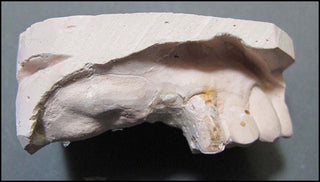 Michener, James. (1907 - 1997) Medical Dental Oddity: Models of Pulitzer Author James A Michener's Teeth [Right Posterior Quadrant]